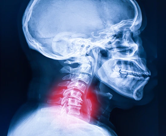 x-ray of a persons neck with a red area highlighting pain